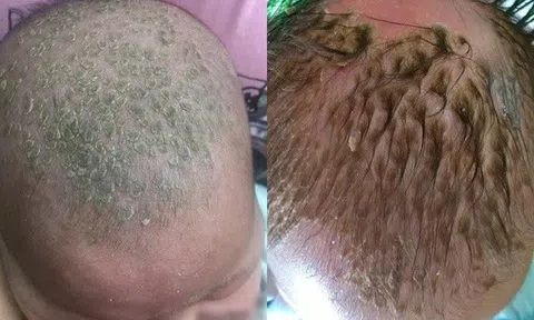 Con 2 tháng da đầu đặc kín "những cục bơ xanh đen", hành động sai lầm của mẹ khiến con nhập viện ngay lập tức