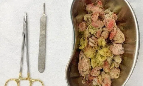 Bé gái 4 tuổi ở Sài Gòn nguy kịch vì ăn nửa con gấu bông