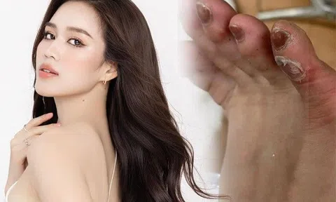 Đánh đổi vài phút lộng lẫy, Đỗ Thị Hà nhận cái kết thương tích đầy mình, móng chân bầm dập