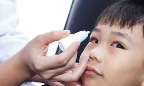 Đau mắt đỏ lây qua đường nào, nhỏ thuốc gì để mau khỏi? Riêng một loại thuốc nhỏ mắt cấm kỵ dùng