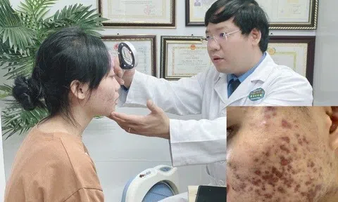 Hãi hùng mặt nữ sinh ở Hà Nội như “tổ ong nghìn lỗ” sau khi làm đẹp bằng thuốc độc quyền tại Spa