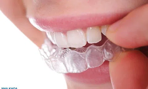 Chuyên gia nha khoa Sài Gòn B.H giải đáp các lưu ý khi niềng răng Invisalign