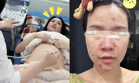 Hot girl Sam lộ nhan sắc tàn phai khi mang thai: Cả người nổi đầy mụn đỏ, không dám đi ra đường