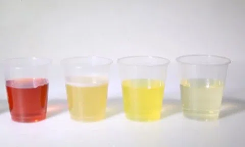Sáng thức dậy thấy nước tiểu màu này đừng vội mừng, hãy đi viện gấp, BS chỉ cách nhìn nước tiểu biết thận khỏe, yếu