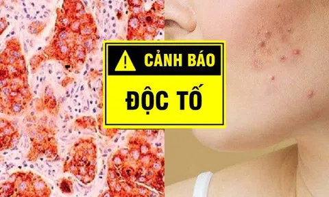 10 dấu hiệu cảnh báo cơ thể ngập độc tố, có điều nhìn bằng mắt thường là nhận ra ngay