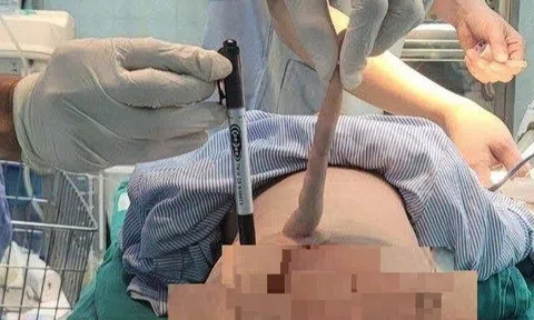Bé trai 4 tháng tuổi ở Thanh Hóa có đuôi dài 14cm