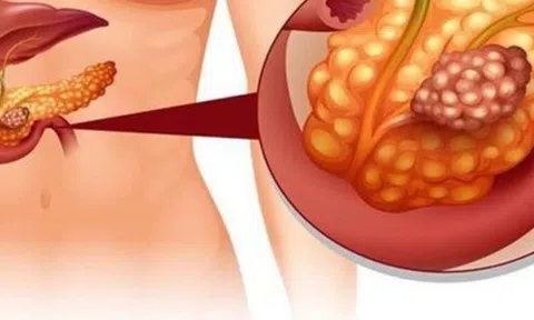 Không hút thuốc, uống rượu, người phụ nữ bị ung thư tuyến tụy, bác sĩ chỉ ra "thủ phạm" không ngờ tới
