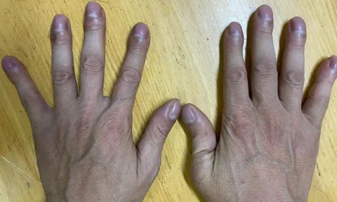 Người đàn ông 44 tuổi đi khám xương khớp bất ngờ phát hiện mắc ung thư phổi từ dấu hiệu ở 10 ngón tay