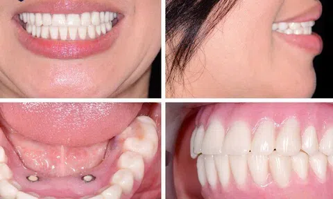 Nha khoa Thành An: Nơi trao gửi niềm tin cho hành trình cấy ghép Implant thành công