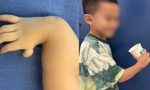 "Tái sinh" bàn tay cho cậu bé mắc dị tật hiếm gặp