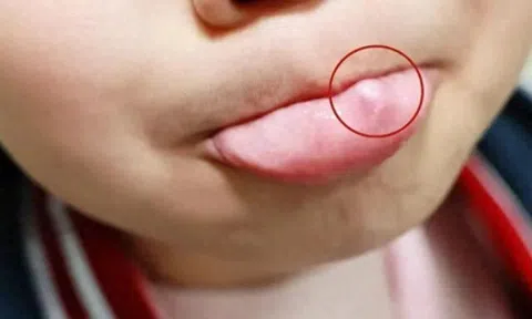 Mẹ tá hoả phát hiện miệng con có khối u bất thường, đến bệnh viện bác sĩ chỉ trích: Là do thói quen này hàng ngày