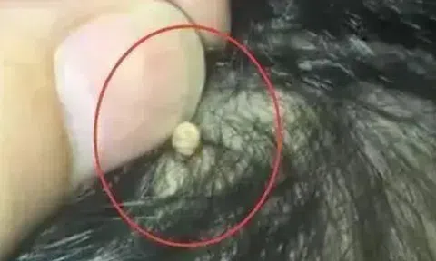 Con kêu đau, mẹ bàng hoàng khi phát hiện "hạt kê" dính chặt ở da đầu, BS nói "Đó là thứ đáng sợ"