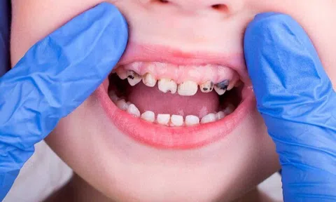 Chỉ vì một hiểu lầm về răng sữa, mẹ vô tình khiến con dễ bị sâu sún răng mà không hay