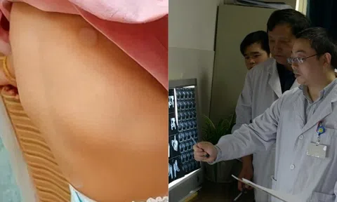 Bé gái mắc bệnh "ngực bồ câu", lời bác sĩ nói khiến người mẹ hối hận