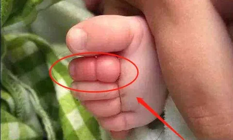 Bố đưa con 2 tuổi đi bơi, lúc về phát hiện ngón chân con phù lên đỏ tấy, đến bệnh viện bác sĩ báo tin sốc