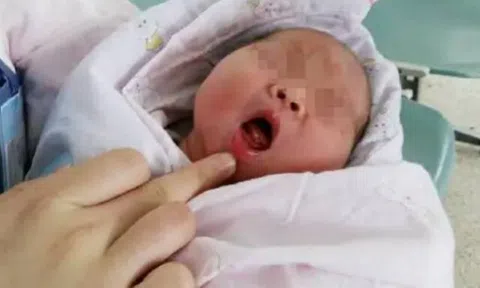 Bé sơ sinh vừa chào đời đã có răng, cả khoa hội chẩn: "Phải nhanh lấy nó ra!"