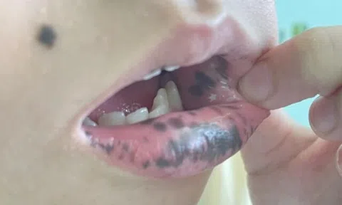 Mẹ phát hiện môi con gái 10 tuổi có nhiều đốm đen kỳ lạ, đến bệnh viện kiểm tra thì kinh hãi nghe bác sĩ nói