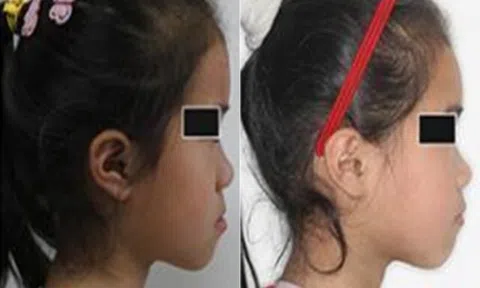 Con gái lúc nhỏ đẹp nhưng càng lớn càng móm, đến bệnh viện bác sĩ nói nguyên nhân khiến gia đình suy sụp