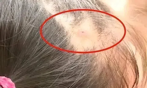 Mẹ phát hiện trên đầu con xuất hiện một lỗ sâu kỳ lạ liền đưa đi khám, đến bệnh viện bác sĩ nói: “Đứa trẻ quá may mắn”