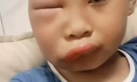 Gửi con về quê nghỉ hè với ông bà, ngày về đón mẹ tá hoả khi mặt đứa trẻ biến dạng