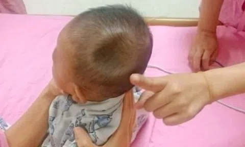 Bé trai 8 tháng tuổi gây xót xa khi đầu bị lõm xuống như một “chiếc hố”, chỉ vì sơ suất nhỏ của bố mẹ