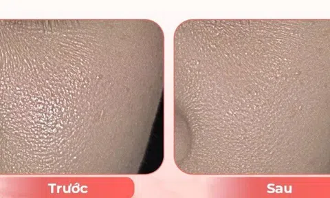 Điều trị lão hóa sắc tố da tuổi trung niên