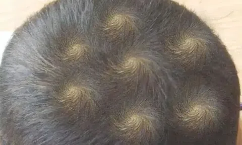 Mẹ phát hiện trên đầu con xuất hiện 7 vòng xoáy kỳ lạ, lo lắng đưa đến viện khám, bác sĩ thốt lên: Thật hiếm gặp!