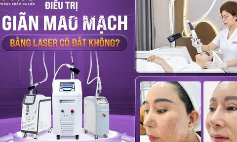 Điều trị giãn mao mạch bằng laser có đắt không?