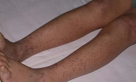 Tắm cho con gái, mẹ phát hiện chân đứa trẻ nổi loạt đốm đỏ, kết quả khám khiến gia đình đau khổ