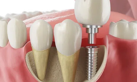 Trồng răng Implant miễn phí giá rẻ có nên không?