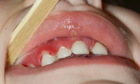 Trẻ thường xuyên bị nhiệt miệng - nguyên nhân và cách xử lý