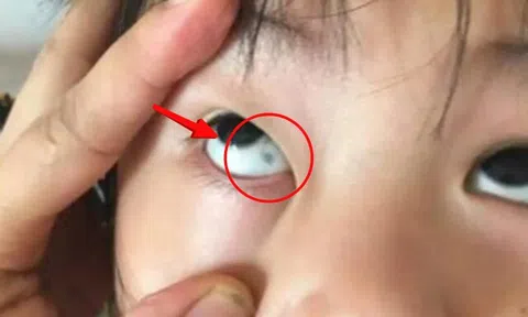 Phát hiện đốm đen trong tròng mắt con, gia đình hoang mang nhanh chóng cho bé nhập viện và cái kết không ngờ