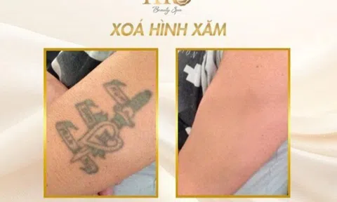 Xóa hình xăm không để lại sẹo và bí mật đằng sau