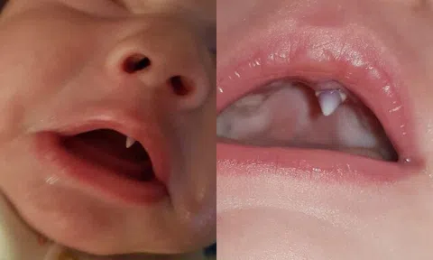 Con 3 tháng tuổi không ngừng khóc, mẹ phát hoảng khi thấy trong miệng con mọc răng nanh, đến bệnh viện bác sĩ lắc đầu