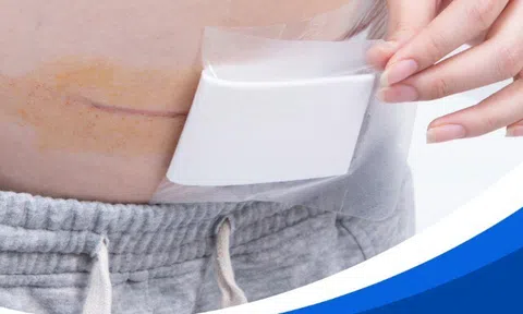 Gạc tiên tiến Hetis – Giải pháp chăm sóc vết mổ sau sinh, phòng ngừa sẹo xấu
