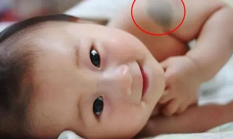Đứa trẻ sở hữu vết bớt ở 10 vị trí này trên cơ thể báo hiệu số kiếp giàu sang phú quý, tương lai tiền tiêu không hết