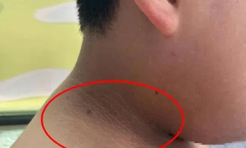 Mẹ phát hiện trên cổ, nách và đùi con trai dậy thì có những "vạch màu đen" kỳ lạ, bác sĩ cảnh báo nguy hiểm
