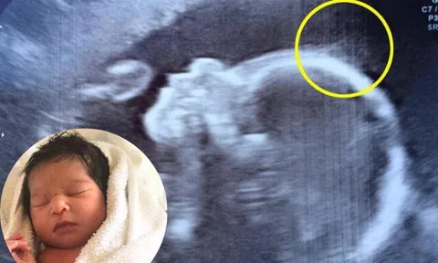 Đến viện siêu âm, mẹ bầu giật mình thấy điểm lạ trên đầu con, cái kết bé gái sinh ra đã nổi tiếng vì quá xinh