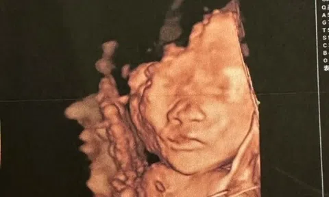 Siêu âm thấy con nhoẻn miệng cười, bố khen đáng yêu quá, bác sĩ: "Em bé không ổn, mẹ chuẩn bị tinh thần"