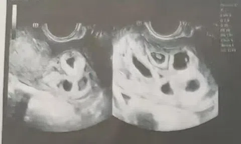 Đến bệnh viện chữa hiếm muộn, cô gái 25 tuổi sốc nặng khi nghe bác sĩ kết luận: Đang mang thai 9 con