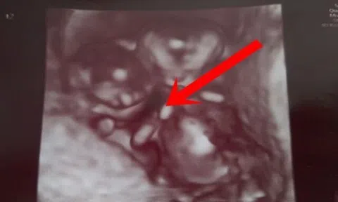 Mẹ bầu mang thai đôi cực đặc biệt, bác sĩ nói đứa trẻ khó sống sót nhưng siêu âm thấy cảnh tượng kỳ diệu