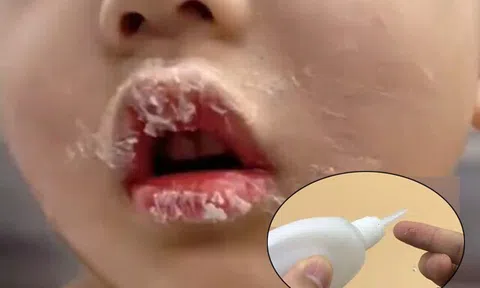 Tưởng keo 502 là son, bé gái bôi lên môi liền bị dính chặt, mẹ tưới thêm 1 thứ được BS khen: Thông minh quá!