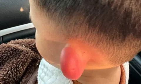 Con qua nhà hàng xóm chơi, về nhà lỗ tai bỗng sưng vù biến dạng, đưa vào viện bác sĩ khen mẹ giỏi