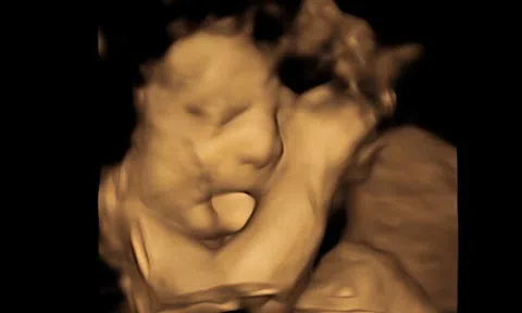 Siêu âm thấy thai nhi thè lưỡi, vợ chồng trẻ khen: "Quá đáng yêu", bác sĩ lại lắc đầu nói: "Chia buồn cùng gia đình"