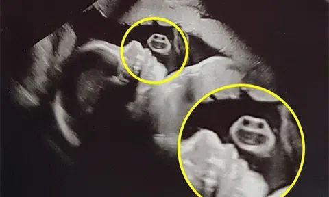 Bức ảnh siêu âm phát hiện một “gương mặt” xuất hiện bên cạnh thai nhi khiến bác sĩ bật cười, mẹ bầu ngơ ngác