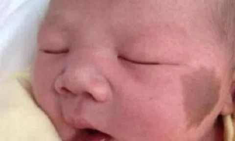 Bé sơ sinh chào đời có vết bớt trên mặt, bác sĩ: Có thể do đã xảy ra những tình huống này trong thai kỳ