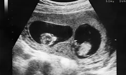 Bị thai nhi đá vào bụng đau điếng phải vào viện siêu âm, thông báo từ bác sĩ khiến bà bầu mừng như "trúng số độc đắc"