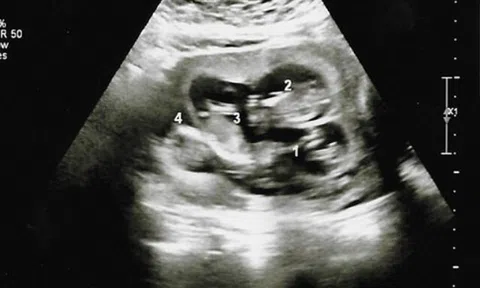 Nghĩ mang song thai, người phụ nữ hoang mang khi 3 lần siêu âm bác sĩ lại thông báo “còn em bé khác”