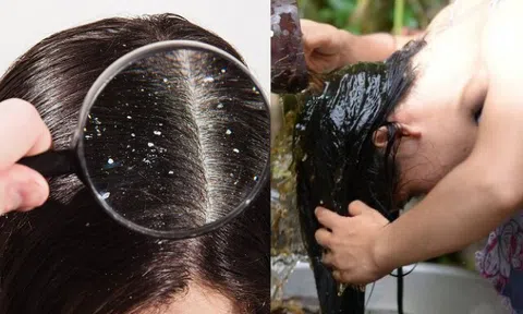 Gội đầu liên tục mà gàu vẫn tróc từng mảng, thử áp dụng những công thức tự nhiên này bạn sẽ sớm ngừng gãi