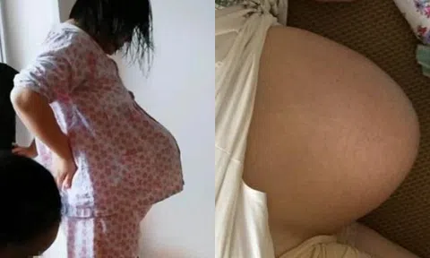 Người phụ nữ mang thai đôi, khoe bụng bầu có hình dáng nhọn hoắt khiến CĐM kinh ngạc, không ngừng xôn xao